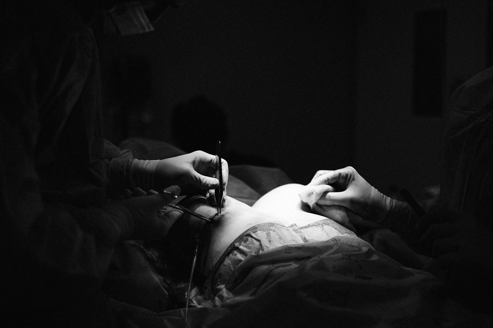 Grayscale Photo of a Surgeon Stitching a Patient's Breast