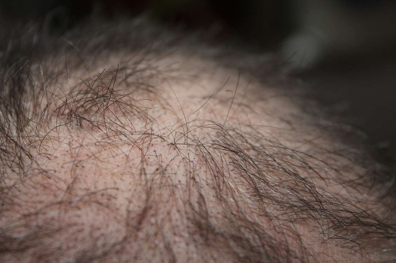 hair, man, hair loss