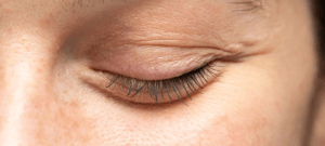 Eyelid Surgery in Turkey
