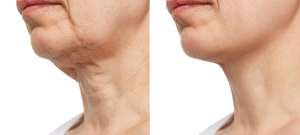 Lower Facelift in Turkey